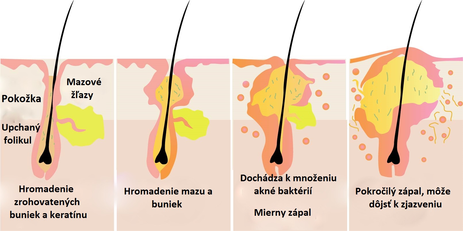 Az akné kialakulásának leírása